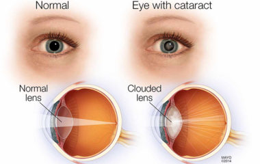 Cataract