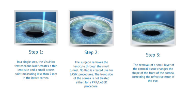 refractive-smile-international-eye-centre